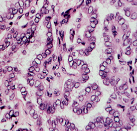 Carcinoma Papilar de Tireóide